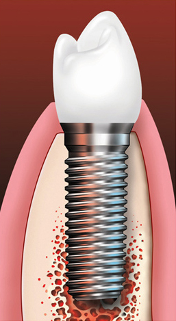 Anatomy_Implant