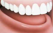 Dentures_Implants_1