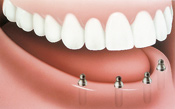 Dentures_Implants_2