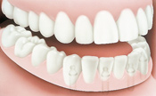 Dentures_Implants_3