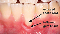 GumRecession_English