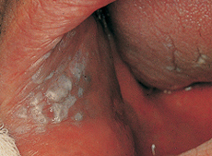 Leukoplakia