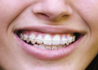 braces-and-orthodontics