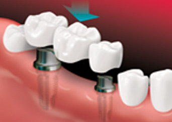 dental-implants