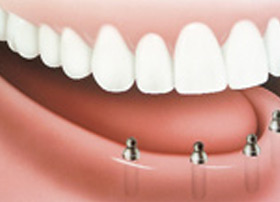 dentures-02