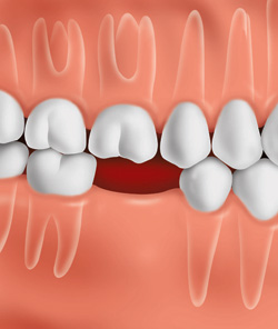 lost-tooth (1)