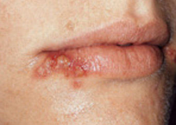 mouth-sores-and-spots