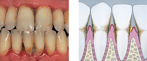 periodontitis