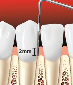 preventing-periodontal-disease-01