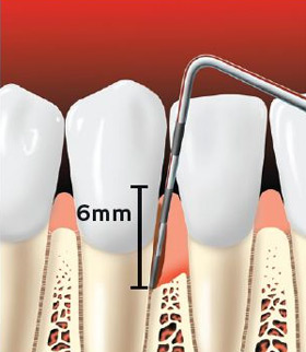 preventing-periodontal-disease-02