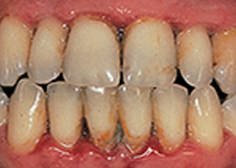 preventing-periodontal-disease