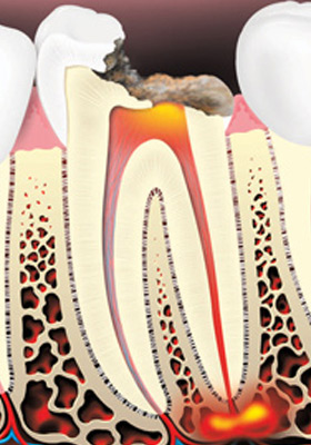 root-canal-treatment-01