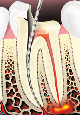 root-canal-treatment-02