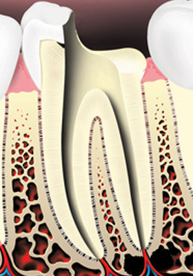 root-canal-treatment-03