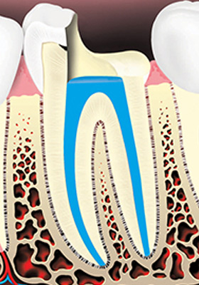 root-canal-treatment-04