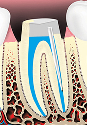 root-canal-treatment-05