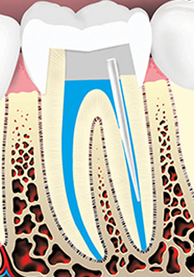 root-canal-treatment-06