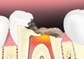 root-canal-treatment