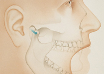 tmd-temporomandibular-disorders