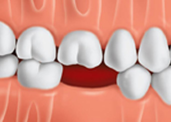 tooth-replacement-options