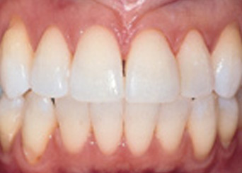 tooth-whitening