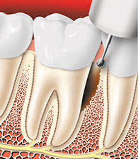 treating-periodontal-disease-01