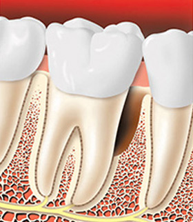 treating-periodontal-disease-02