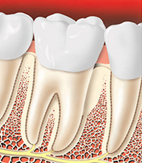 treating-periodontal-disease-04