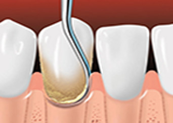 treating-periodontal-disease